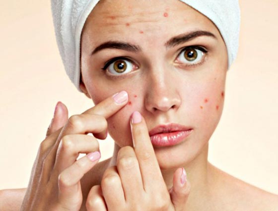 الطريقة المثلى لمعالجة حب الشباب صورة رقم 1