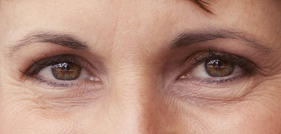 اليك أفضل 5 وصفات طبيعية للتخلص من التجاعيد صورة رقم 5