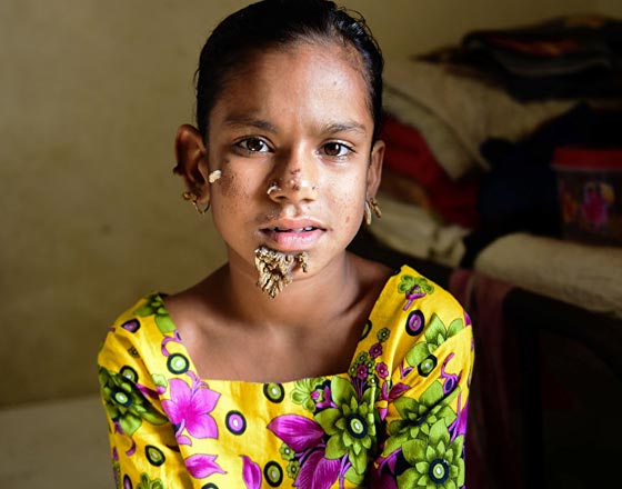 اليكم قائمة بأغرب الأمراض التي تصيب البشر صورة رقم 1