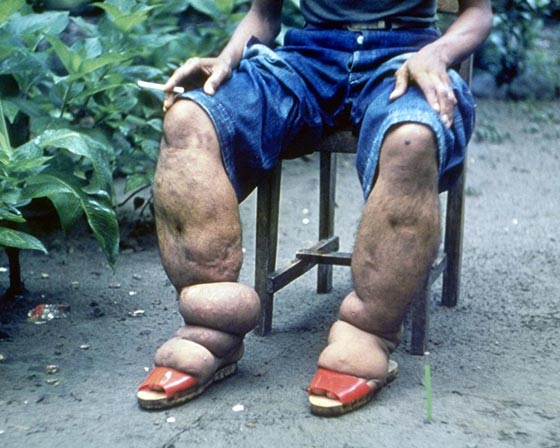 اليكم قائمة بأغرب الأمراض التي تصيب البشر صورة رقم 5