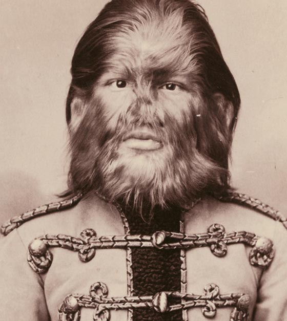 اليكم قائمة بأغرب الأمراض التي تصيب البشر صورة رقم 7