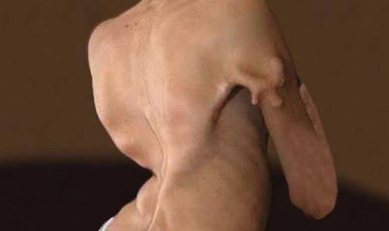 اليكم قائمة بأغرب الأمراض التي تصيب البشر صورة رقم 6