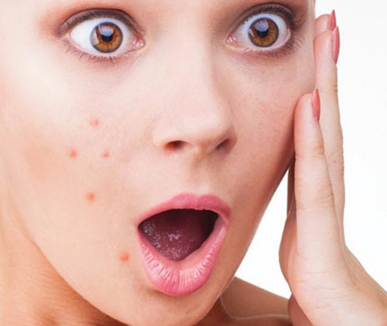 10 عادات تجنبوها للوقاية من حب الشباب صورة رقم 1