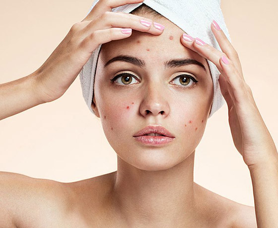 طرق مدهشة للتخلص من الزوان وحبّ الشباب  صورة رقم 3