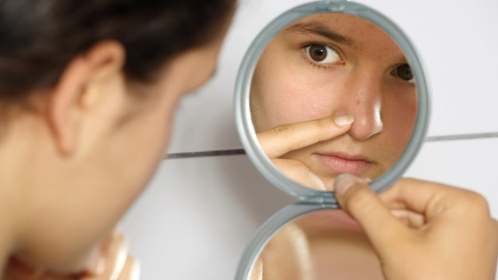 طرق مدهشة للتخلص من الزوان وحبّ الشباب  صورة رقم 1