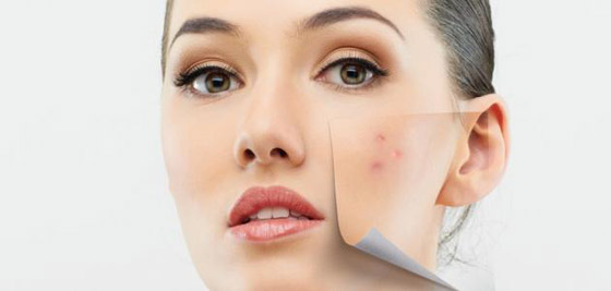 طرق مدهشة للتخلص من الزوان وحبّ الشباب  صورة رقم 4