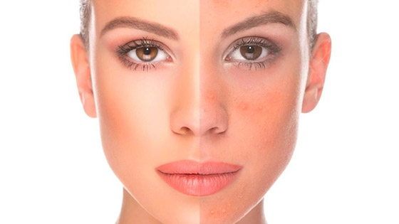 مشاكل حب الشباب.. اليكم حلولها صورة رقم 5