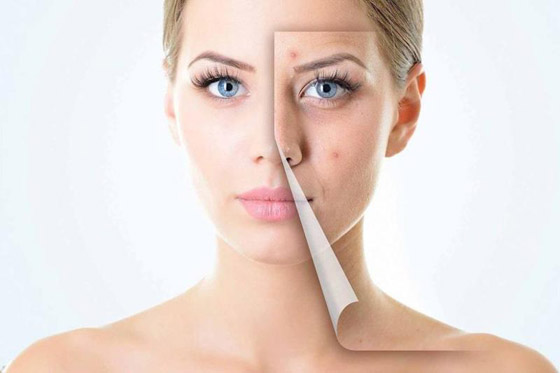 مجموعة نصائح للتخلص من آثار حب الشباب والجروح صورة رقم 2