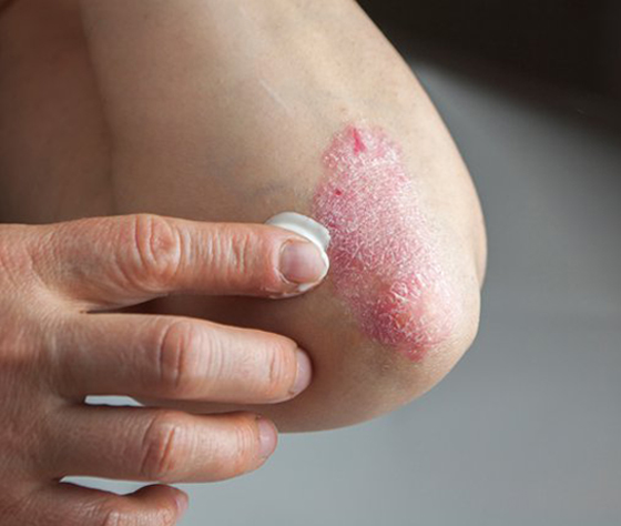 تعرفوا على أسباب الصدفية، أنواعها وأعراضها، طرق علاجها ومضاعفاتها صورة رقم 10