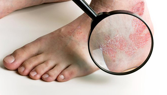 تعرفوا على أسباب الصدفية، أنواعها وأعراضها، طرق علاجها ومضاعفاتها صورة رقم 13