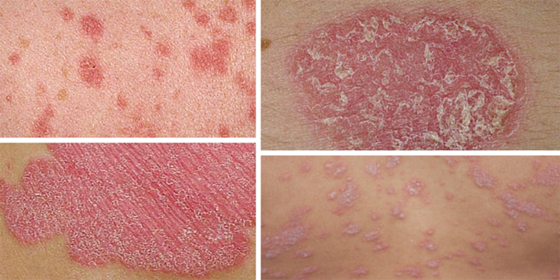 تعرفوا على أسباب الصدفية، أنواعها وأعراضها، طرق علاجها ومضاعفاتها صورة رقم 6