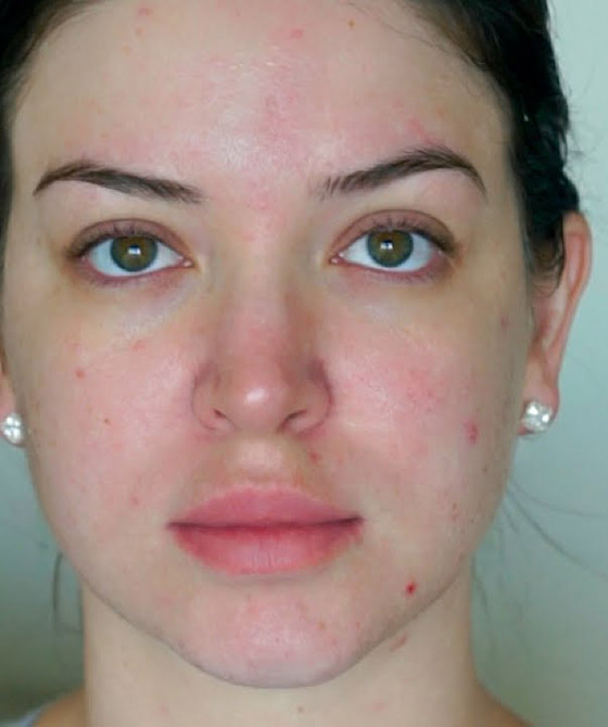 احذري.. مستحضرات التجميل تهدد البشرة بهذا المرض صورة رقم 6