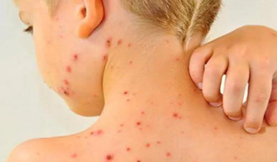 ما هي الحصبة، ولماذا ترجع إلى عالمنا الأن؟ صورة رقم 1