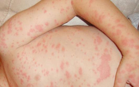 ما هي الحصبة، ولماذا ترجع إلى عالمنا الأن؟ صورة رقم 7