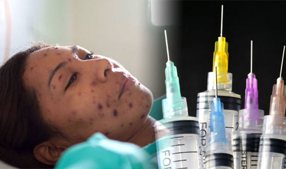 ما هي الحصبة، ولماذا ترجع إلى عالمنا الأن؟ صورة رقم 3