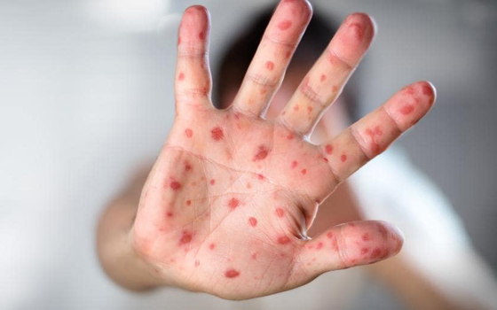 ما هي الحصبة، ولماذا ترجع إلى عالمنا الأن؟ صورة رقم 4