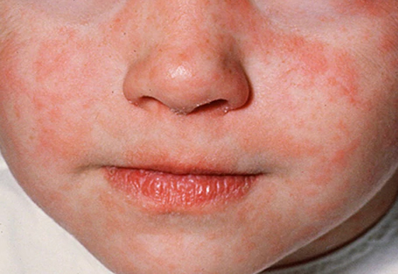 ما هي الحصبة، ولماذا ترجع إلى عالمنا الأن؟ صورة رقم 14