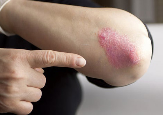 تعرفوا على أسباب الصدفية، أنواعها وأعراضها، طرق علاجها ومضاعفاتها صورة رقم 1