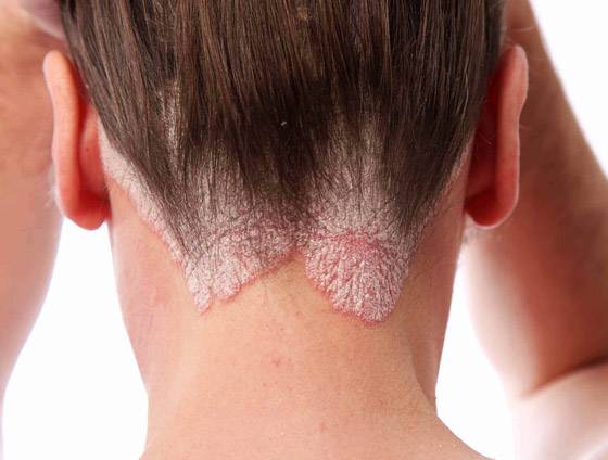 تعرفوا على أسباب الصدفية، أنواعها وأعراضها، طرق علاجها ومضاعفاتها صورة رقم 2