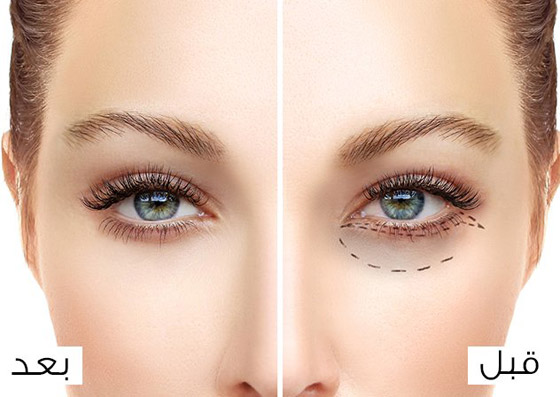 للحفاظ على نظرات شابة ومشرقة .. لكل عمر عناية خاصة لمحيط العينين صورة رقم 3