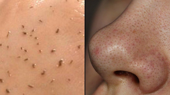 أفضل الخلطات الطبيعية لإزالة الرؤوس السوداء والتخلص منها صورة رقم 6 أفضل الخلطات الطبيعية لإزالة الرؤوس السوداء والتخلص منها صورة رقم 6