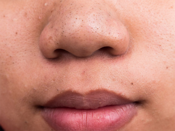 أفضل الخلطات الطبيعية لإزالة الرؤوس السوداء والتخلص منها صورة رقم 7 أفضل الخلطات الطبيعية لإزالة الرؤوس السوداء والتخلص منها صورة رقم 7