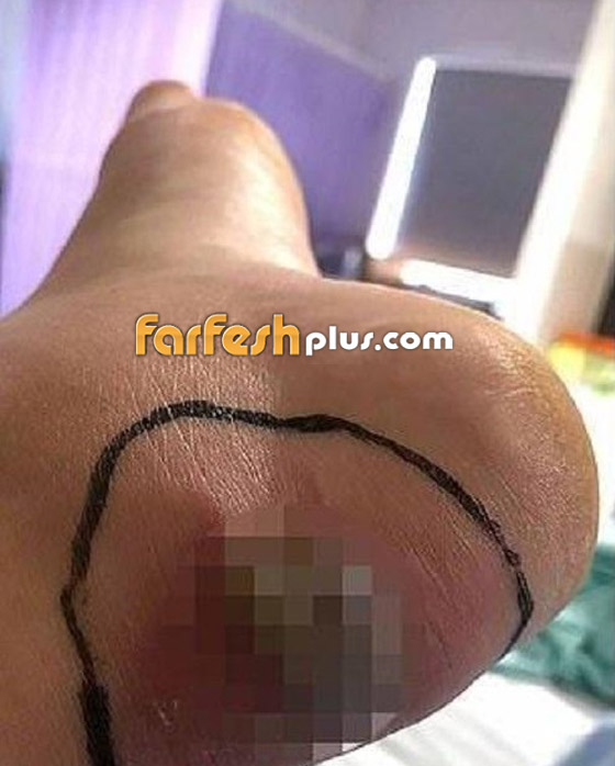عارضة ازياء شهيرة تواجه خطر بتر قدمها بسبب حذاء... وهذه التفاصيل صورة رقم 5