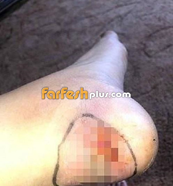 عارضة ازياء شهيرة تواجه خطر بتر قدمها بسبب حذاء... وهذه التفاصيل صورة رقم 2