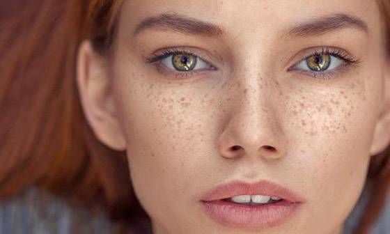 هكذا تتخلصين من البقع البنية التي يتركها الصيف على بشرتك صورة رقم 4