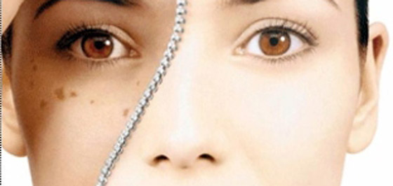 هكذا تتخلصين من البقع البنية التي يتركها الصيف على بشرتك صورة رقم 1