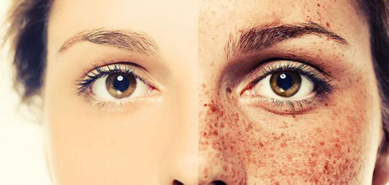 هكذا تتخلصين من البقع البنية التي يتركها الصيف على بشرتك صورة رقم 2