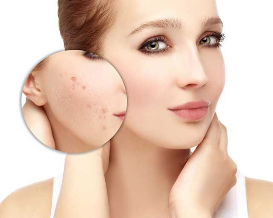 الطريقة المثلى لمعالجة حب الشباب صورة رقم 2