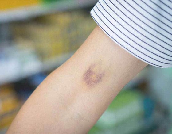 ما أسباب ظهور كدمات الجسم دون سبب؟ صورة رقم 8