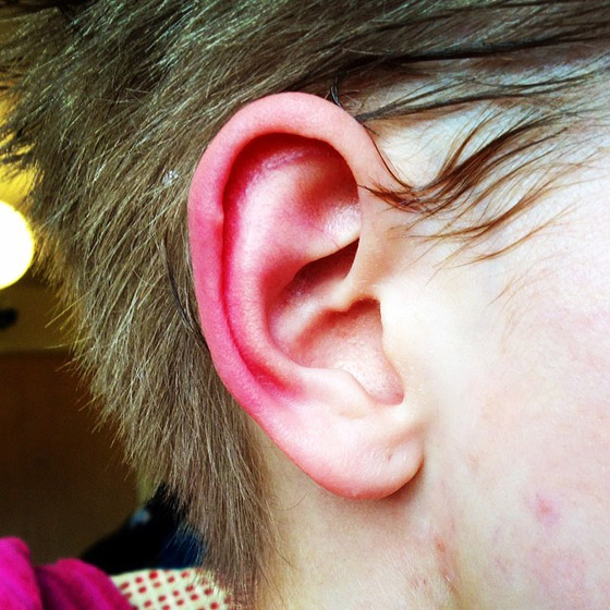 ليس كما تظن.. احمرار الأذن حالة طبية يجب علاجها.. وهذه الأسباب! صورة رقم 3 ليس كما تظن.. احمرار الأذن حالة طبية يجب علاجها.. وهذه الأسباب! صورة رقم 3