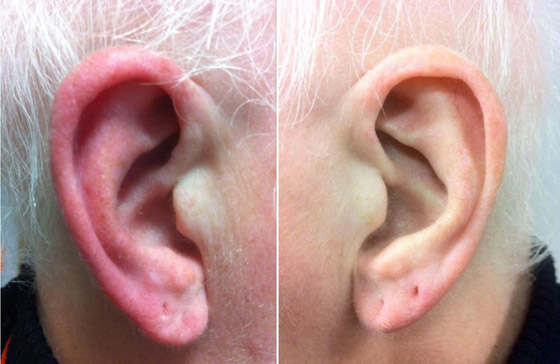 ليس كما تظن.. احمرار الأذن حالة طبية يجب علاجها.. وهذه الأسباب! صورة رقم 7 ليس كما تظن.. احمرار الأذن حالة طبية يجب علاجها.. وهذه الأسباب! صورة رقم 7