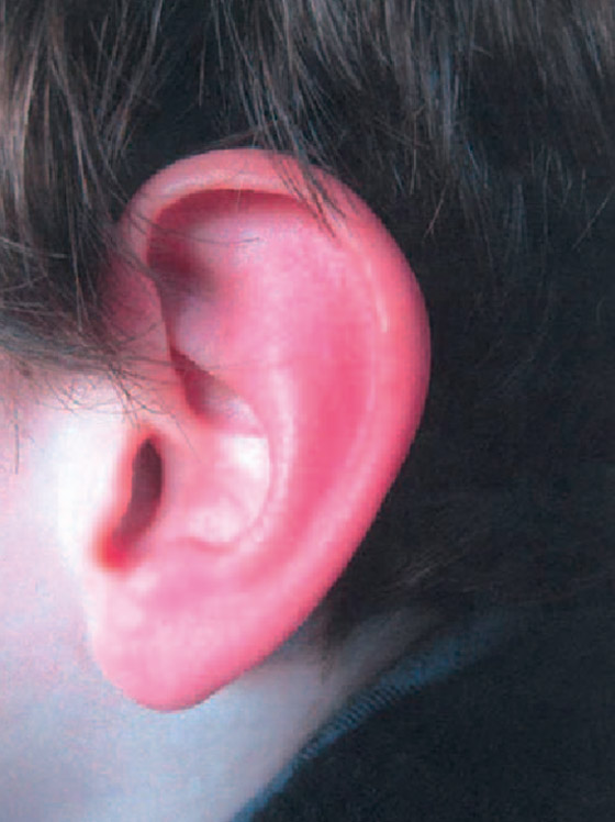 ليس كما تظن.. احمرار الأذن حالة طبية يجب علاجها.. وهذه الأسباب! صورة رقم 13 ليس كما تظن.. احمرار الأذن حالة طبية يجب علاجها.. وهذه الأسباب! صورة رقم 13