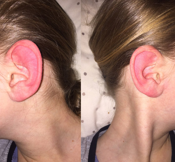 ليس كما تظن.. احمرار الأذن حالة طبية يجب علاجها.. وهذه الأسباب! صورة رقم 9 ليس كما تظن.. احمرار الأذن حالة طبية يجب علاجها.. وهذه الأسباب! صورة رقم 9