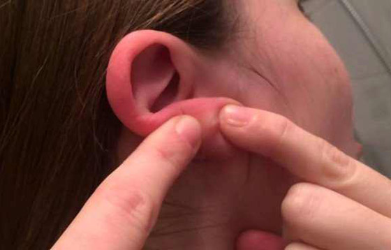 ليس كما تظن.. احمرار الأذن حالة طبية يجب علاجها.. وهذه الأسباب! صورة رقم 11 ليس كما تظن.. احمرار الأذن حالة طبية يجب علاجها.. وهذه الأسباب! صورة رقم 11