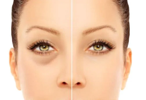 5 خطوات تحميك من الهالات الداكنة.. تعرفي عليها صورة رقم 6