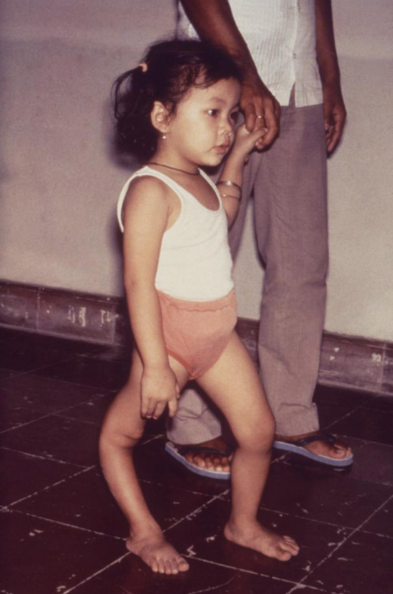 في اليوم العالمي لشلل الأطفال.. مسؤولو الصحة يعلنون انتصارا في مكافحته صورة رقم 2