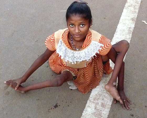 في اليوم العالمي لشلل الأطفال.. مسؤولو الصحة يعلنون انتصارا في مكافحته صورة رقم 7