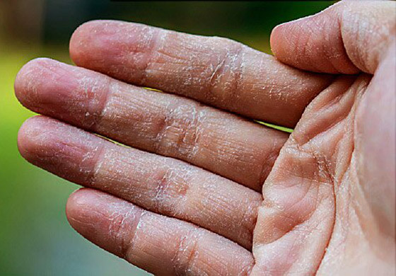 أسباب تشقق اليدين وطرق العلاج والعناية بهما في فصل الشتاء صورة رقم 3
