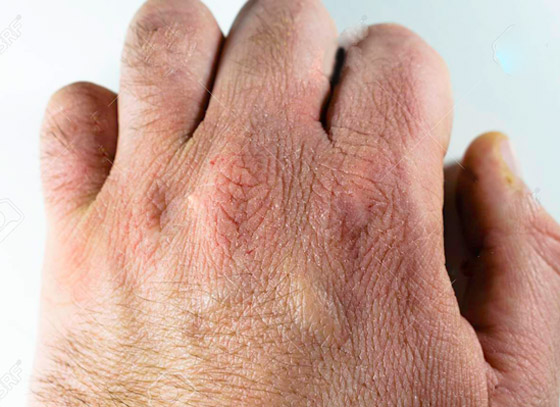 أسباب تشقق اليدين وطرق العلاج والعناية بهما في فصل الشتاء صورة رقم 2