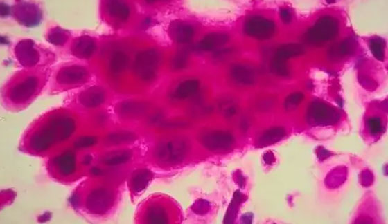 4 عادات سيئة تؤدي للإصابة بسرطان الرئة صورة رقم 4