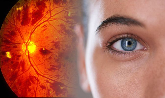 سرطان العين.. أسبابه، أعراضه وطرق اكتشافه ومعالجته صورة رقم 5