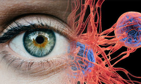 سرطان العين.. أسبابه، أعراضه وطرق اكتشافه ومعالجته صورة رقم 3