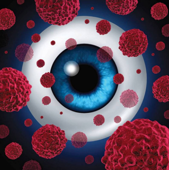 سرطان العين.. أسبابه، أعراضه وطرق اكتشافه ومعالجته صورة رقم 2