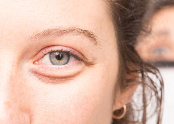 إليك كل شيء تريد معرفته عن انتفاخات أسفل العين وأسبابها وطرق علاجها صورة رقم 2