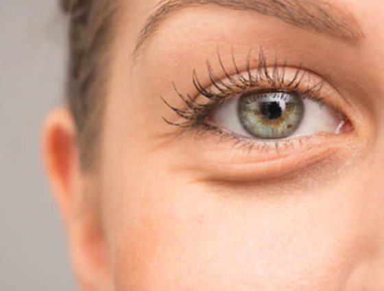 إليك كل شيء تريد معرفته عن انتفاخات أسفل العين وأسبابها وطرق علاجها صورة رقم 11