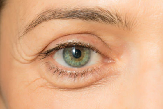 إليك كل شيء تريد معرفته عن انتفاخات أسفل العين وأسبابها وطرق علاجها صورة رقم 7